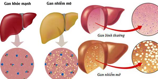 Phân biệt gan nhiễm mỡ và gan bình thường