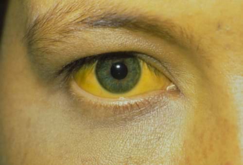 Vàng da, vàng mắt xuất hiện nhiều ở giai đoạn mãn tính