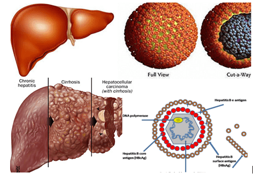 Cách điều trị viêm gan B mạn tính thể hoạt động